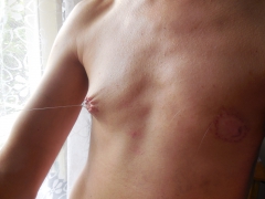 My tits in pain (nipples removed) - N